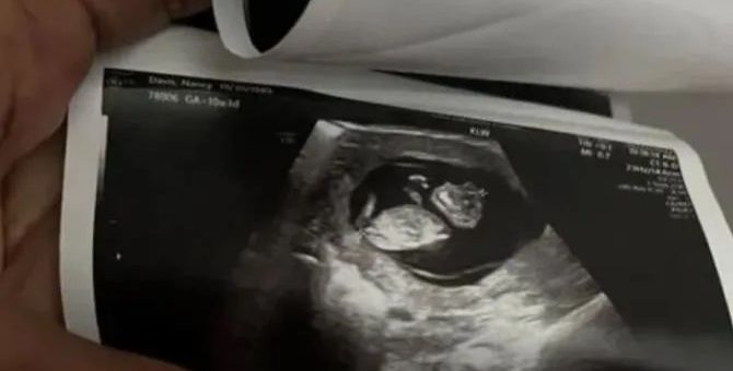產檢發現胎兒有致命缺陷。醫生：本州禁止墮胎，必須繼續懷著，直到ta死...